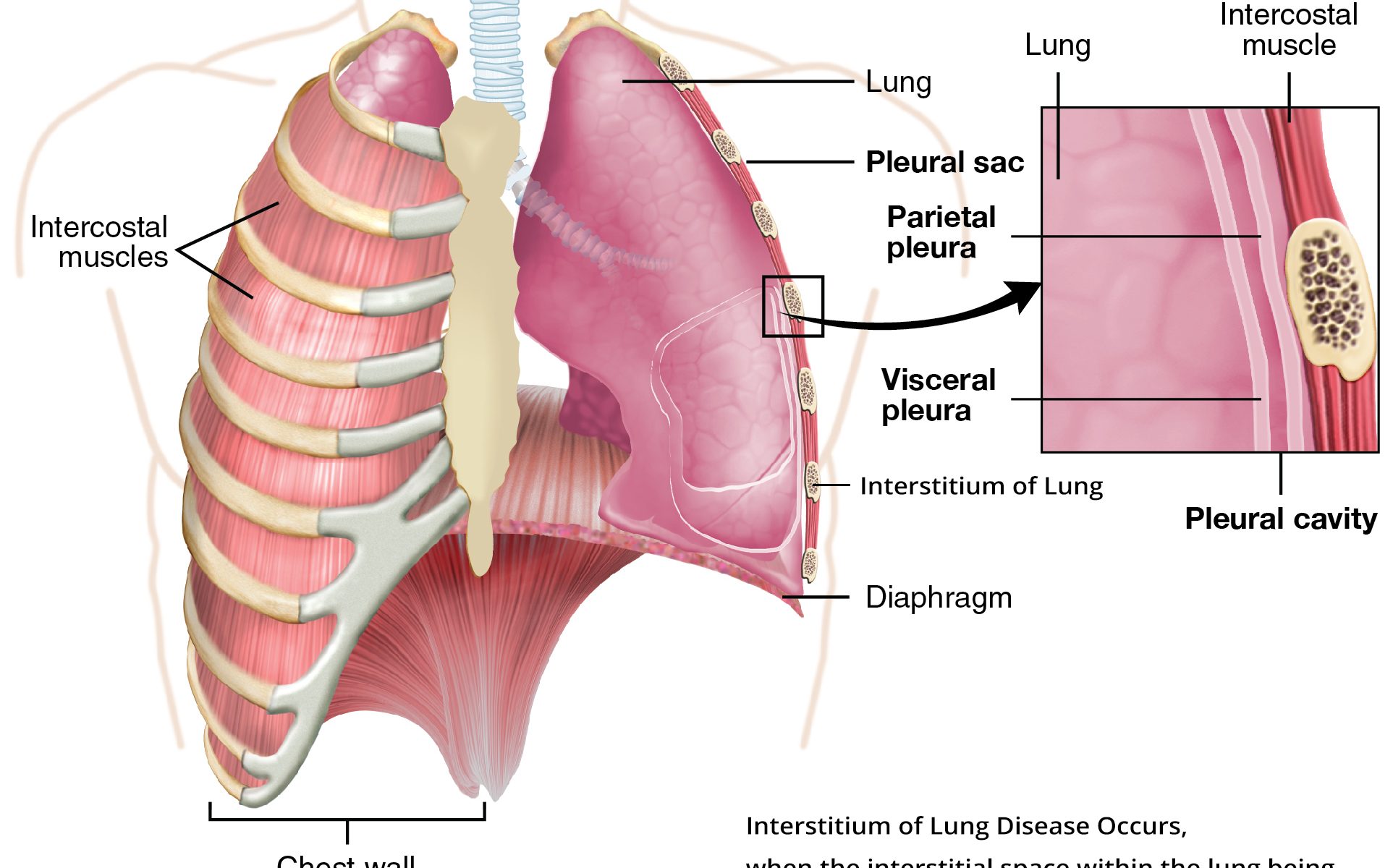 interstitium lung disease